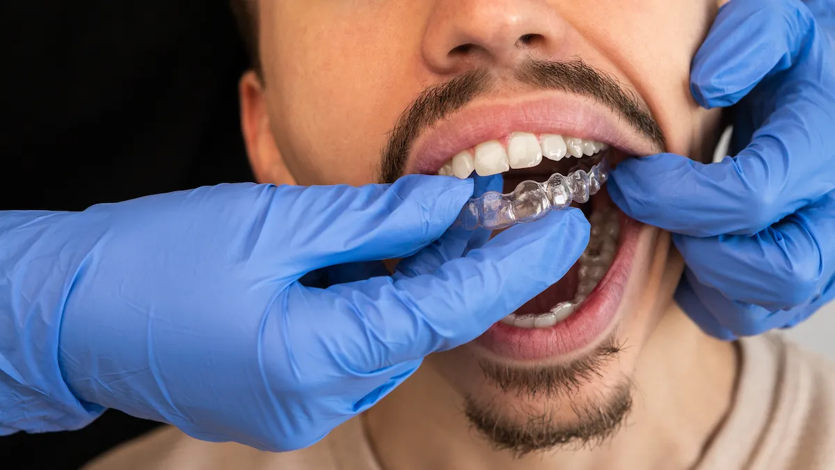 What Invisalign Process can do?