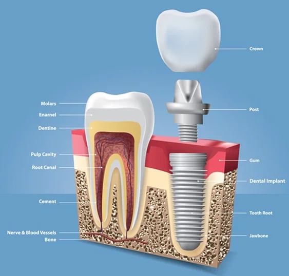 Dental implants in chennai  |Dr. Vikram’s Align