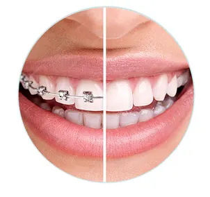 Braces vs Invisalign Pros and Cons – Which is Right for You? 1 Braces vs Invisalign Pros and Cons