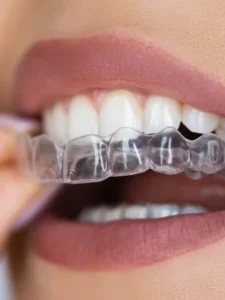 cropped-Aligners-for-Crooked.webp
