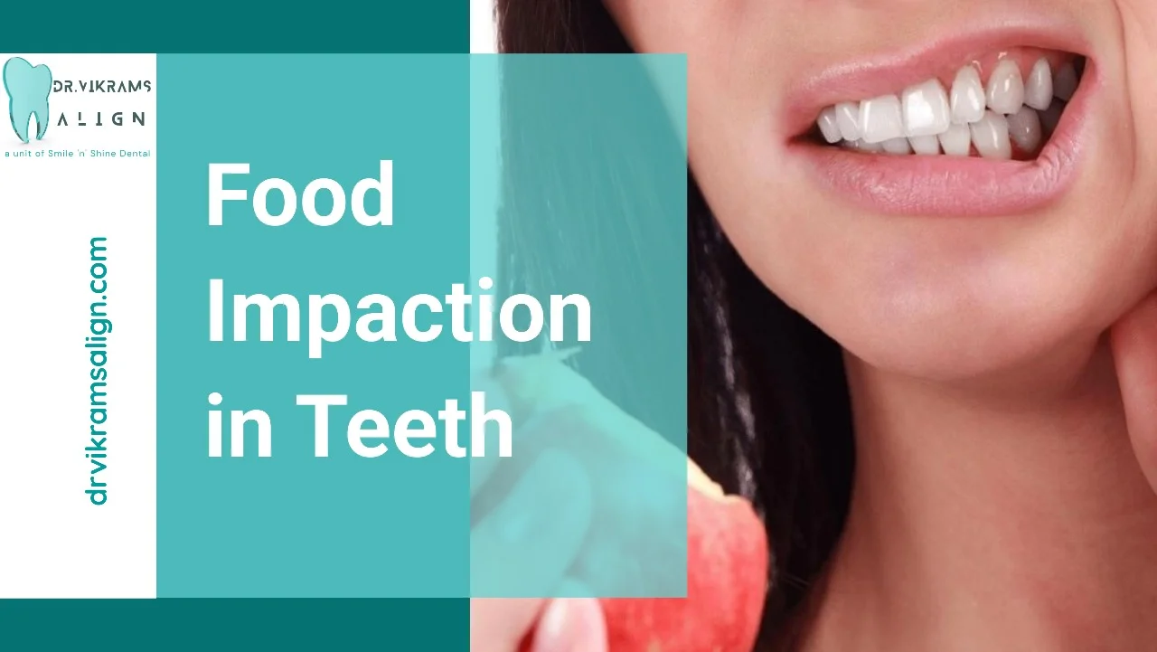 food impaction in teeth