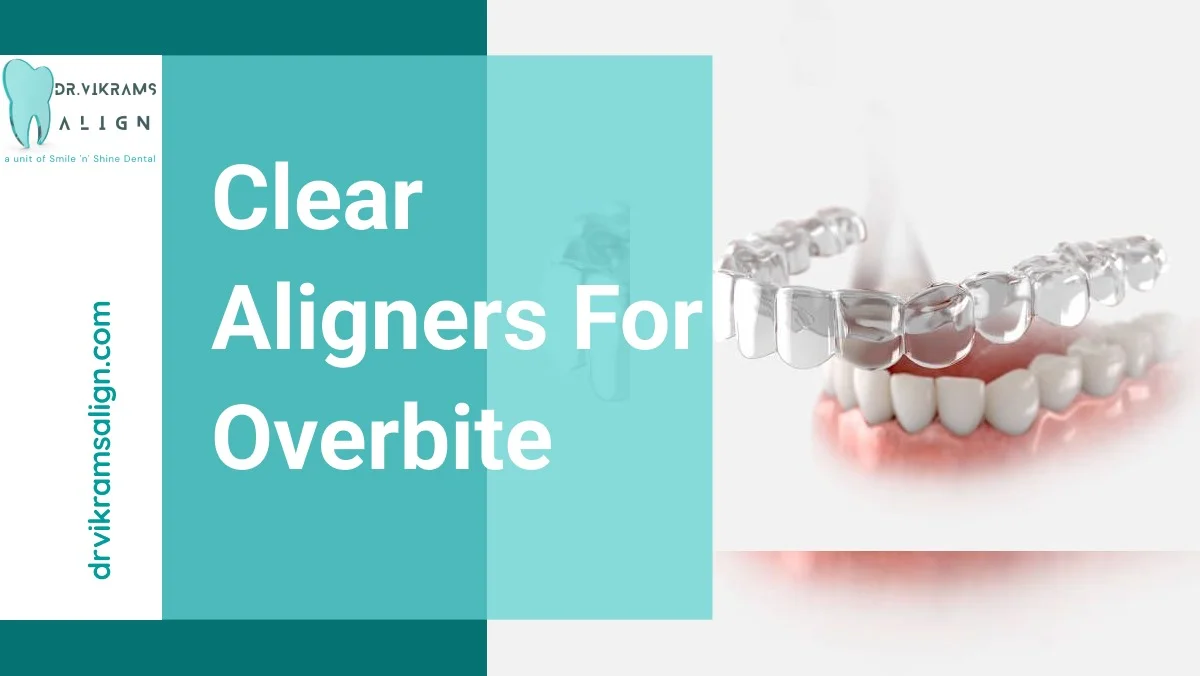 clear aligners for overbite